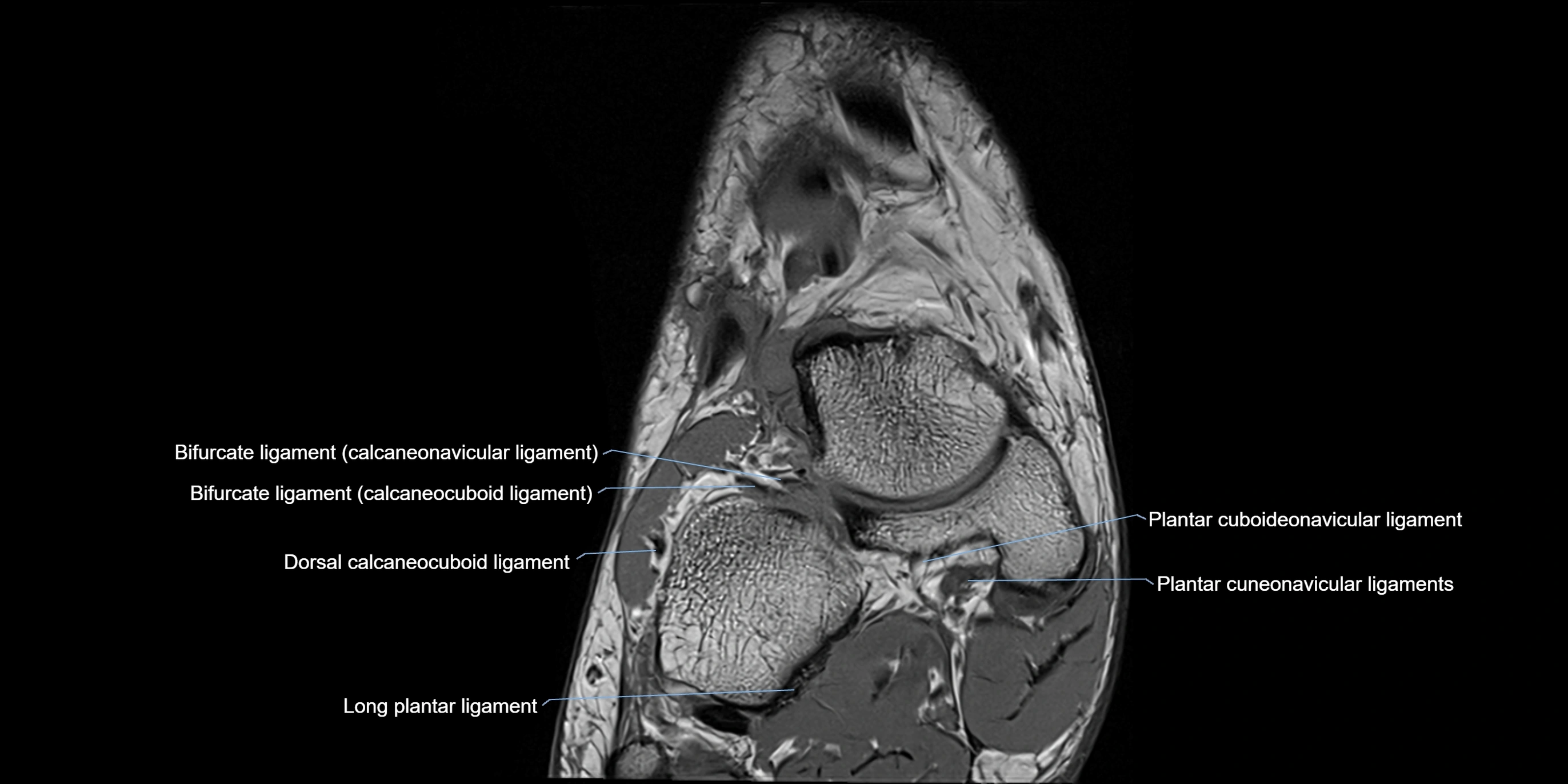 MRI Ankle coronal ligaments cross sectional anatomy 3T  radiology  image-img-00001-00002.webp
